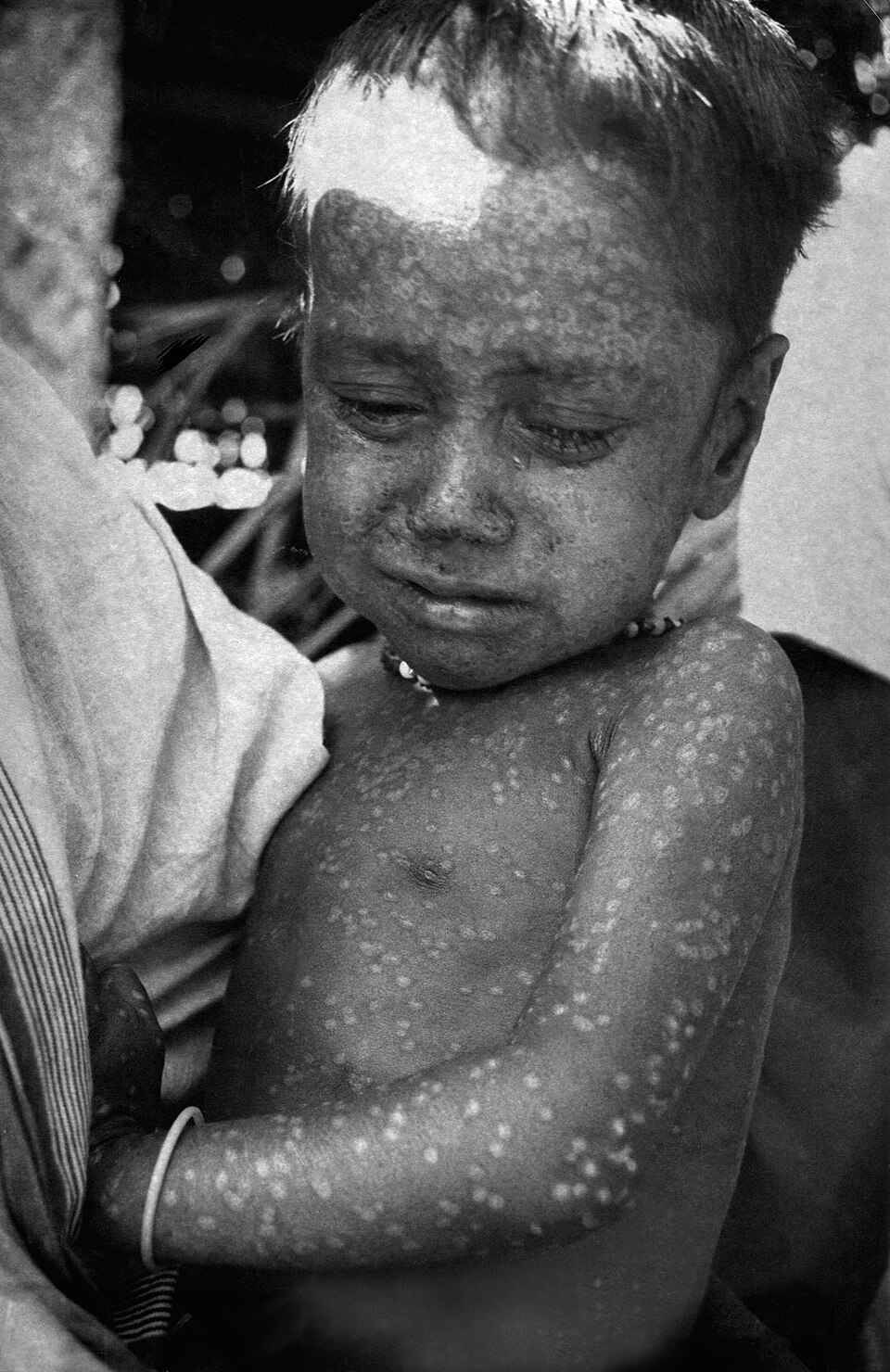 CDC/ World Health OrganizationStanley O. Foster M.D., M.P.H., Public domain, via Wikimedia Commons